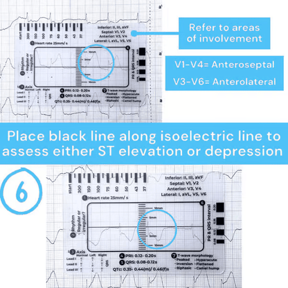 (🔥HOT SALE NOW 60% OFF) -ECG 7 Step Ruler